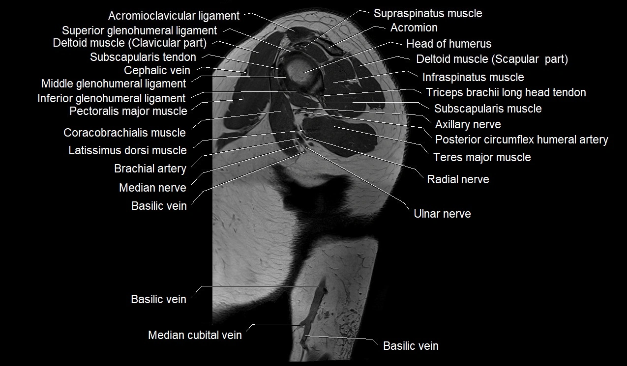 Upper arm (humerus ) saittal cross sectional anatomy 3T image 26.webp